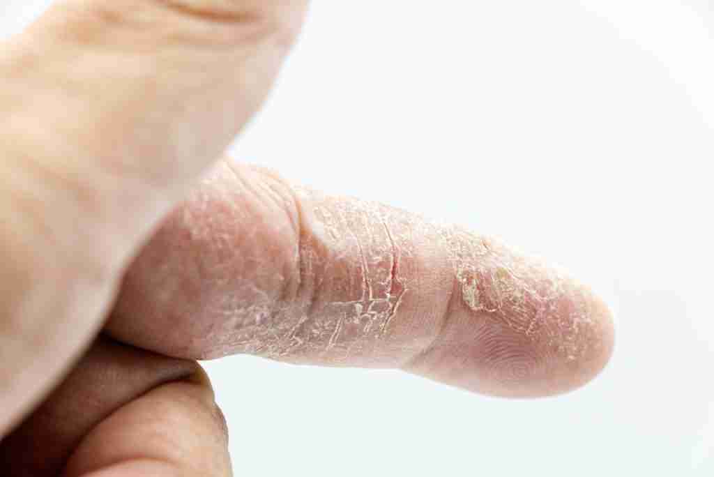 Close-up of Dry Skin on a Finger